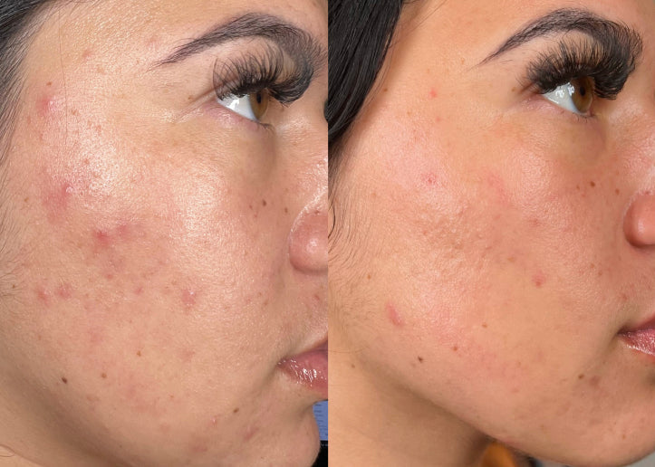 https://www.hydrafacial.com/cdn/shop/files/Before_After_Mobile_Acne.jpg?v=1756180430
