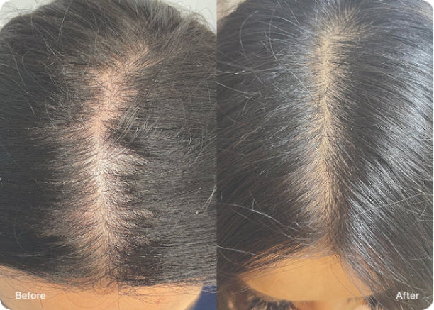 Voor en na resultaten van HydraScalp met Keravive behandeling